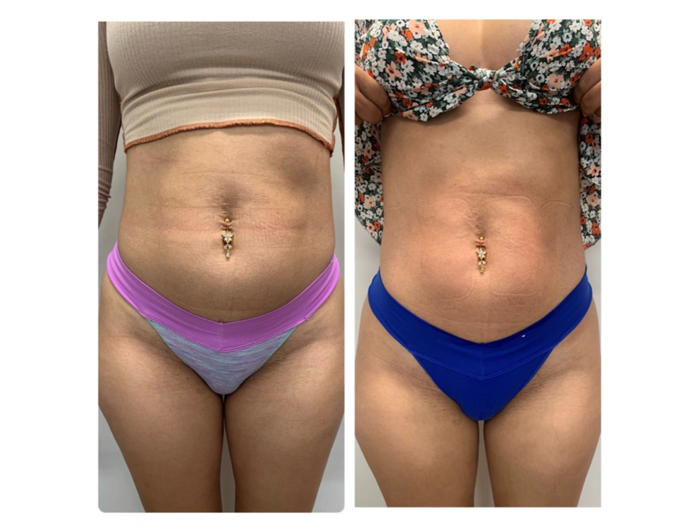 before and after body contouring