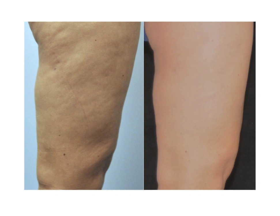 before and after body contouring