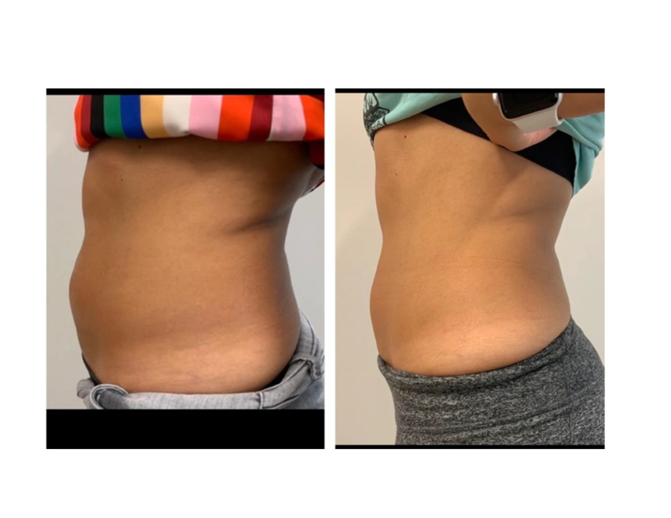 before and after body contouring