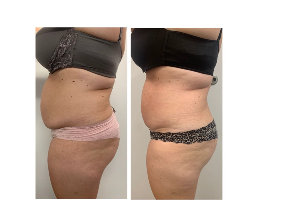 before and after body contouring