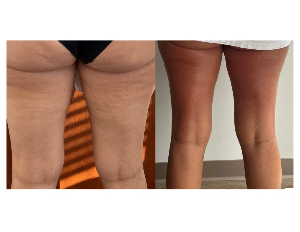 before and after body contouring