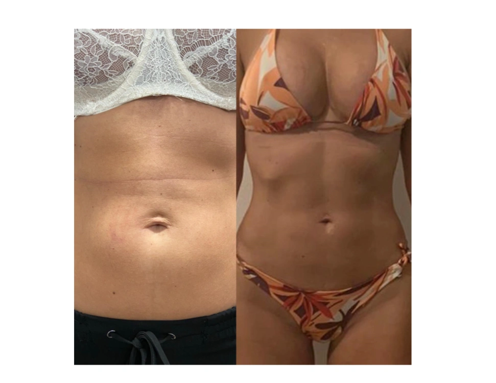 before and after body contouring