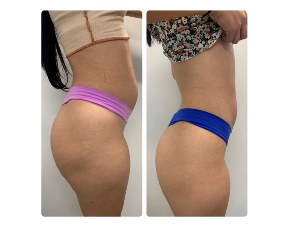 before and after body contouring