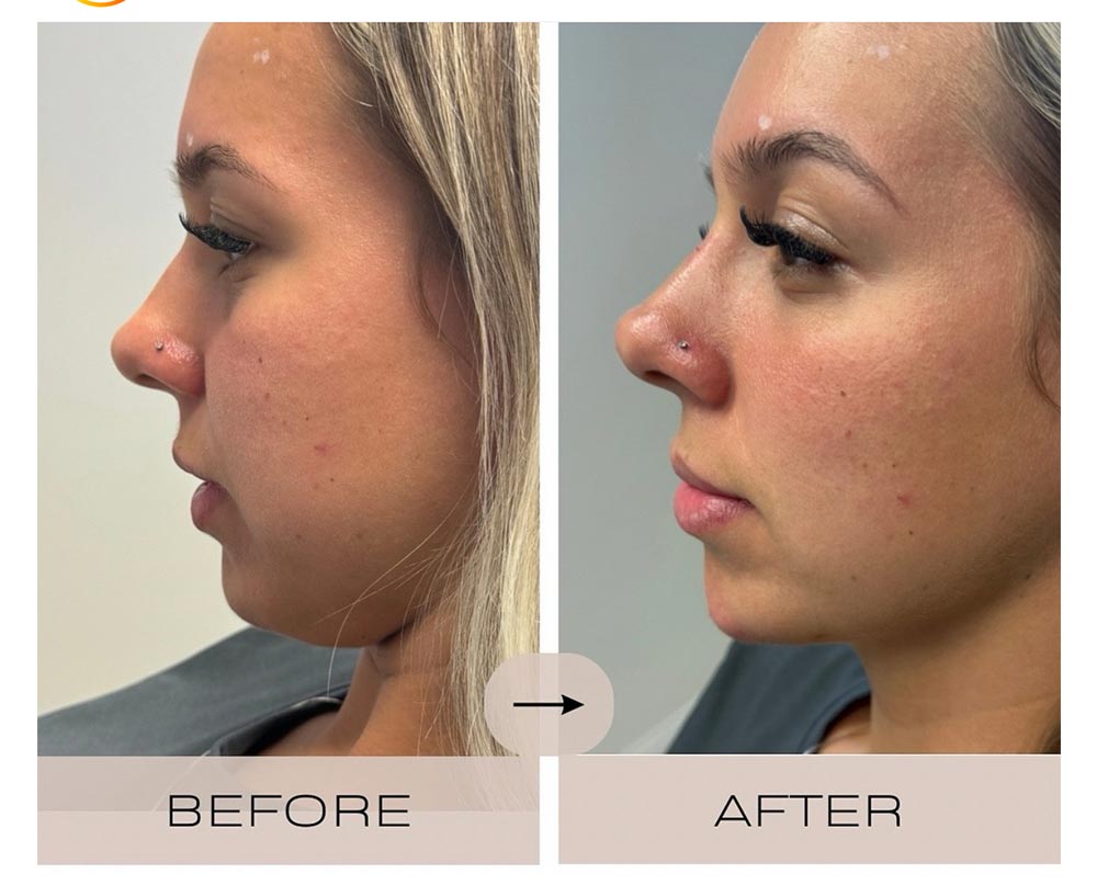 injectables before and after case eight