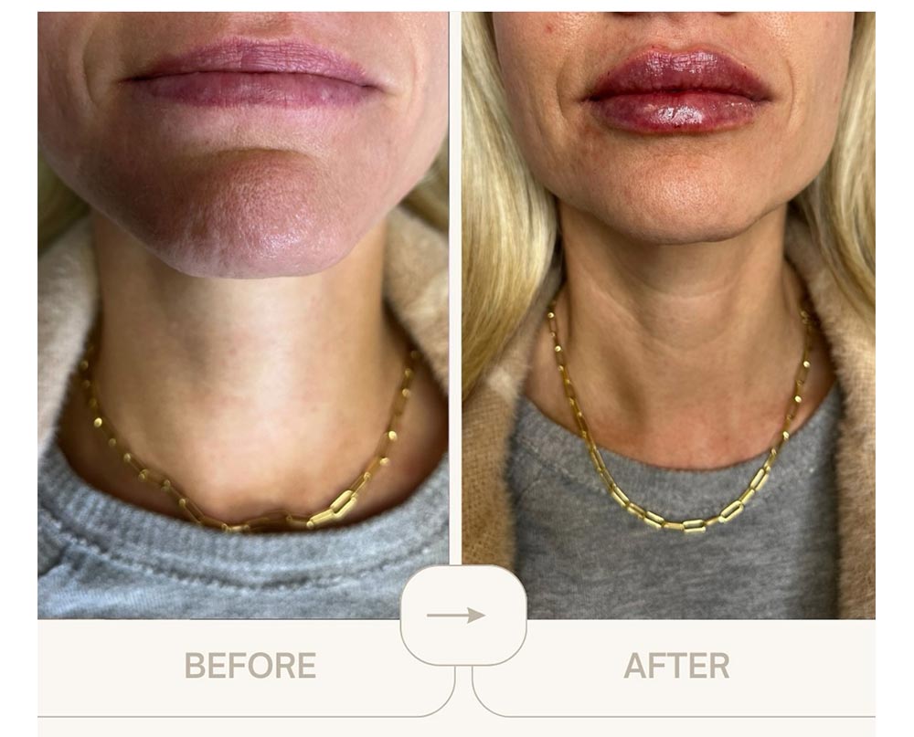 injectables before and after case eleven