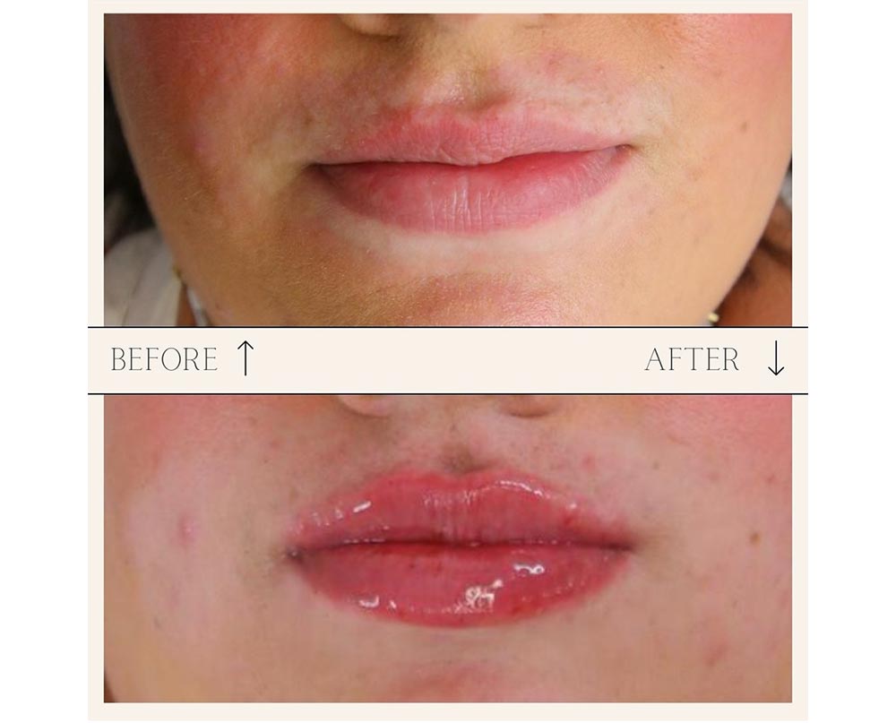 injectables before and after case five