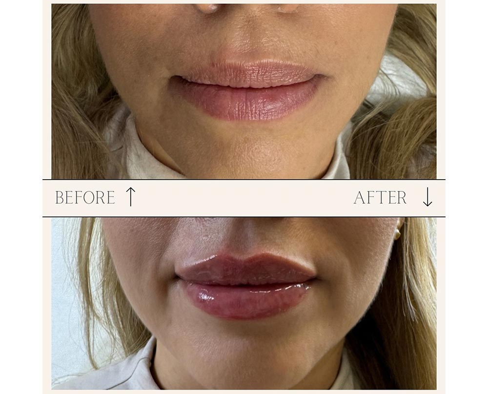 injectables before and after case four