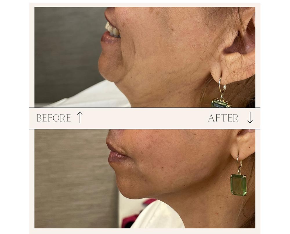 injectables before and after case nine