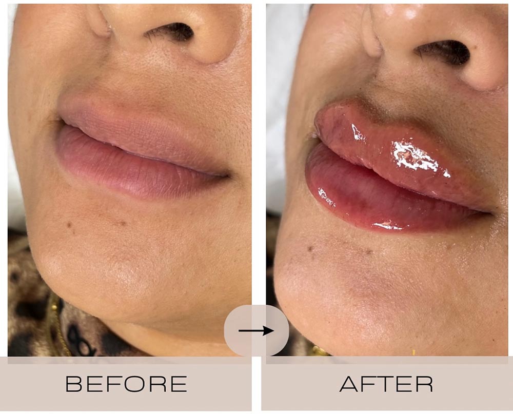 injectables before and after case one