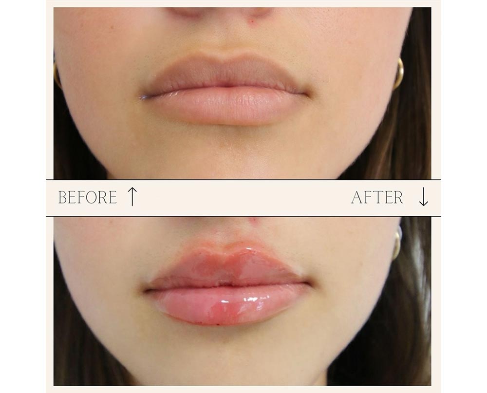 injectables before and after case seven