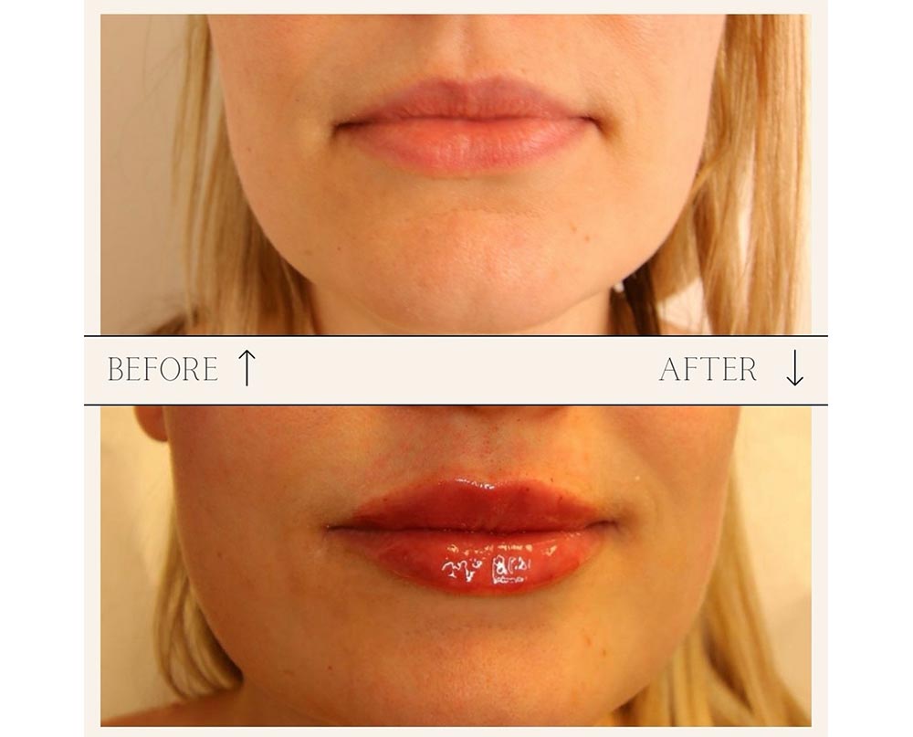 injectables before and after case six