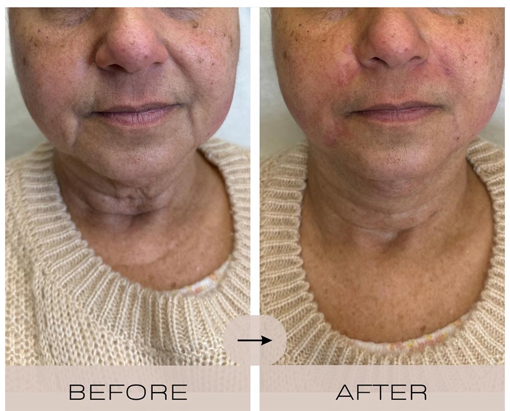 injectables before and after case ten