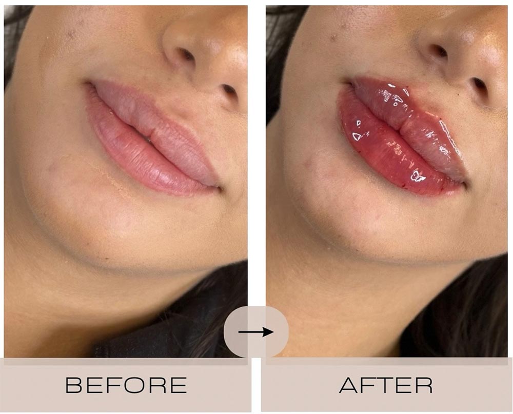 injectables before and after case three