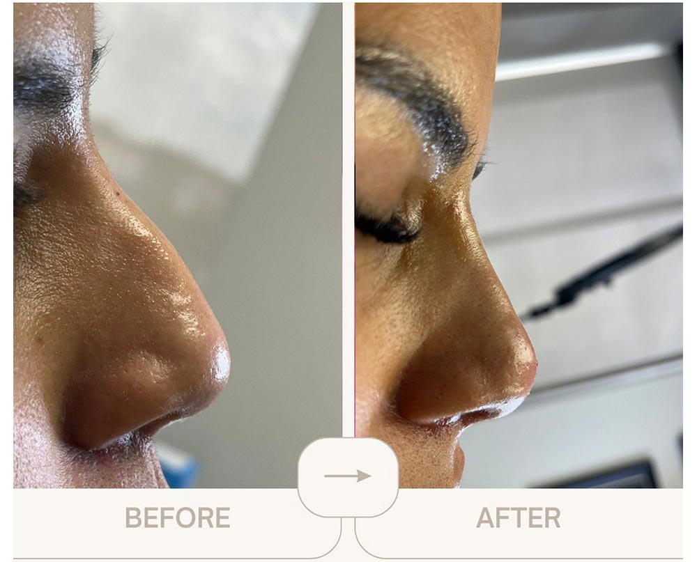 injectables before and after case twelve