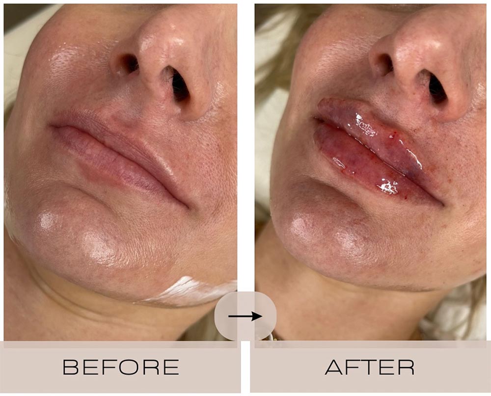 injectables before and after case two